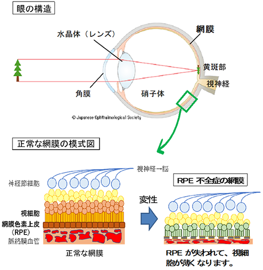 「網膜色素上皮（RPE）不全症に対する同種iPS細胞由来RPE細胞懸濁液移植に関する臨床研究」について