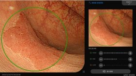 内視鏡ＡＩ診断支援医療機器ソフトウェア 「ＷＩＳＥ ＶＩＳＩＯＮ 内視鏡画像解析ＡＩ」医療機器承認