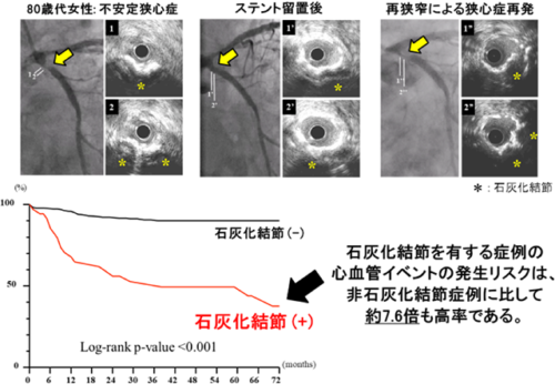 石灰化結節に起因する急性心筋梗塞に対する薬剤溶出性ステントを用いたカテーテル治療の有効性
