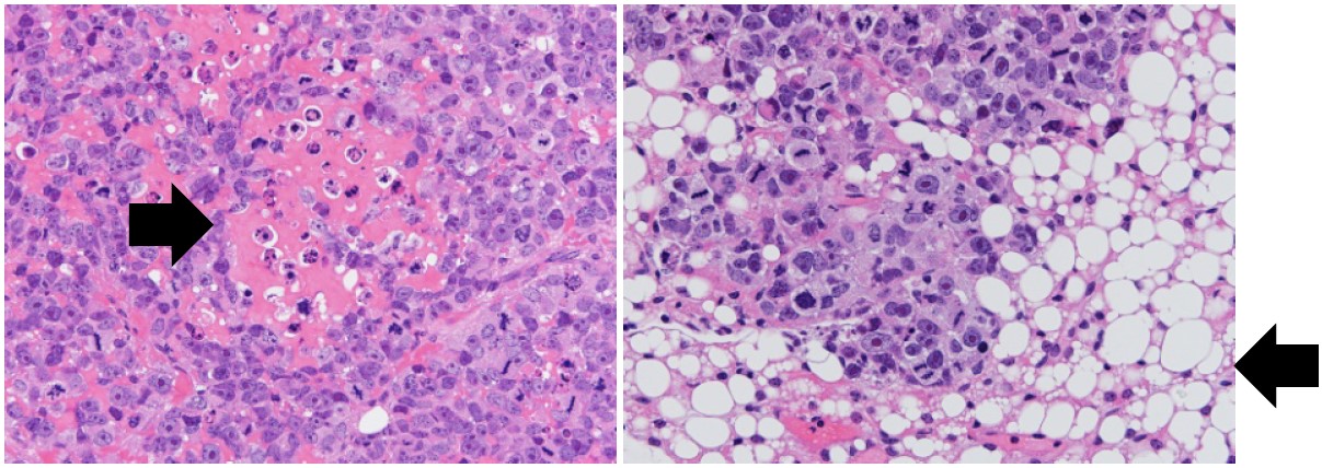 骨肉腫を脂肪細胞へ変化させることに成功～TNIK阻害薬活用による新規治療法開発への期待～