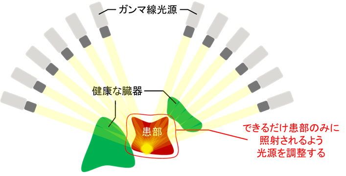 脳腫瘍などの放射線治療計画を短時間で生成する技術を開発