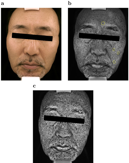 潜在的なシミをデジタル写真で計測する新手法～人工知能で肌の紫外線写真を生成して色素斑を計測～