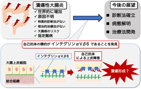 指定難病「潰瘍性大腸炎」の自己抗体発見～新たな診断や治療開発へ～