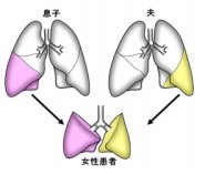 医学部附属病院において新型コロナウイルス感染後の肺障害に対する生体肺移植を行いました。（2021年4月7日）