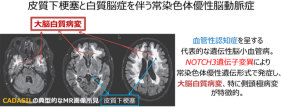 遺伝性脳小血管病CADASILに対する新薬 医師主導治験開始へ