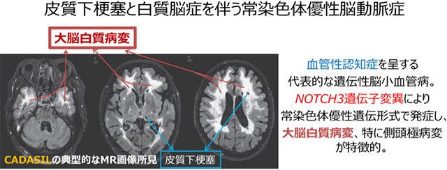 遺伝性脳小血管病CADASILに対する新薬 医師主導治験開始へ