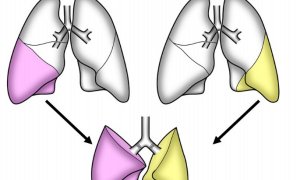医学部附属病院において新型コロナウイルス感染後の肺障害に対する生体肺移植を行いました。（2021年4月7日）