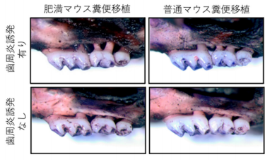 肥満が歯周病を悪化させる仕組みを解明～腸内細菌は歯周病に影響を与える～