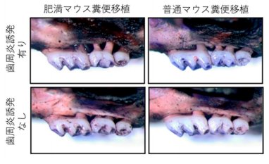 肥満が歯周病を悪化させる仕組みを解明～腸内細菌は歯周病に影響を与える～
