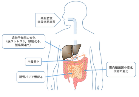 非アルコール性脂肪性肝疾患悪化に歯周病原細菌による腸内環境への悪影響が関係する