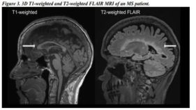 多発性硬化症における神経変性の定量的MRIバイオマーカー(Quantitative MRI Biomarkers of Neurodegeneration in Multiple Sclerosis)