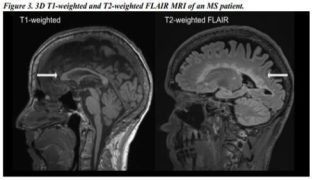 多発性硬化症における神経変性の定量的MRIバイオマーカー(Quantitative MRI Biomarkers of Neurodegeneration in Multiple Sclerosis)