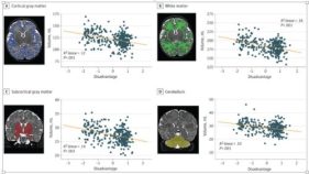 貧困や犯罪が新生児の脳の違いに関係していることが判明(Poverty, crime linked to differences in newborns’ brains)