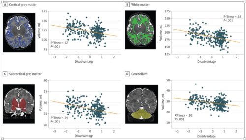 貧困や犯罪が新生児の脳の違いに関係していることが判明(Poverty, crime linked to differences in newborns’ brains)