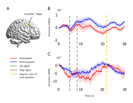 吃音予期が脳内の特異な活動を促すことを発見(Study finds stuttering anticipation prompts unique activity in the brain)