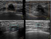 日本初の乳がん超音波検診における精密検査の要否判定を行う人工知能(AI)を開発～専門医を凌駕する精度で画像診断を行い、乳がん検診の精度向上に貢献～