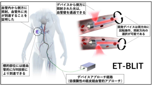 体を隅々まで照らす新規生体光デバイス・システムを開発 血管内治療技術を応用した光照射デバイス・システム(ET-BLIT)開発に成功 ~さまざまな光治療技術の臨床応用に道を切り開く~ 体を隅々まで照らす新規生体光デバイス・システムを開発 血管内治療技術を応用した光照射デバイス・システム(ET-BLIT)開発に成功 ~さまざまな光治療技術の臨床応用に道を切り開く~