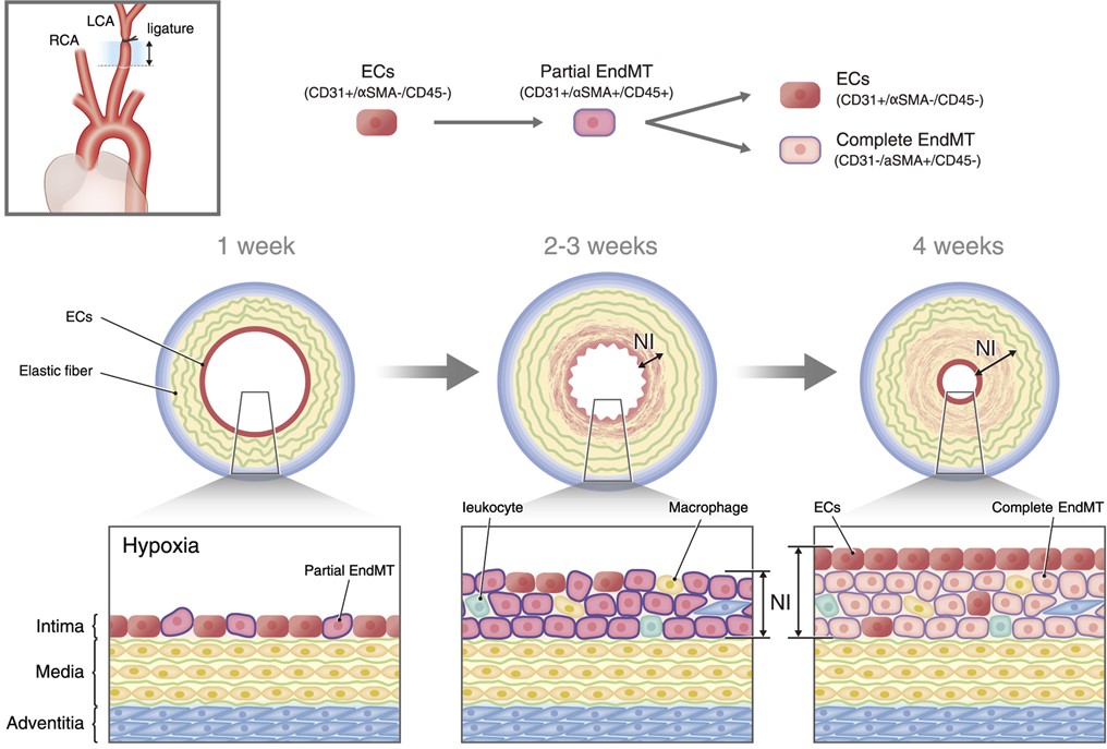 血管狭窄時の新生内膜形成に内皮間葉転換が寄与する 〜血管リモデリングの仕組みを解明〜