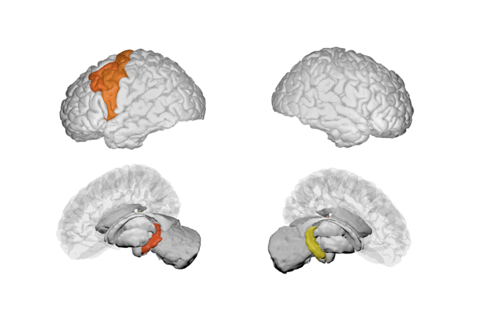 幻聴に関連した脳構造特徴を発見