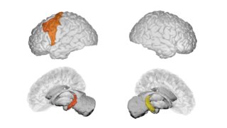 幻聴に関連した脳構造特徴を発見
