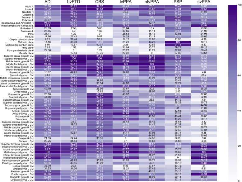 AIが希少な認知症を検出(AI detects rare forms of dementia)