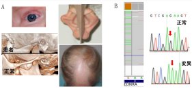 たった一つのアミノ酸変異で先天性希少疾患を起こす機序を原子のレベルから解明
