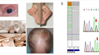 たった一つのアミノ酸変異で先天性希少疾患を起こす機序を原子のレベルから解明