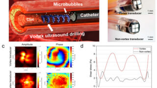 超音波の「トルネード」で血栓を分解する新ツールを開発(New Tool Uses Ultrasound &lsquo;Tornado&rsquo; to Break Down Blood Clots)
