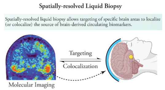 集束超音波技術により神経変性疾患のバイオマーカーを放出することに成功(Focused ultrasound technique leads to release of neurodegenerative disorders biomarkers)