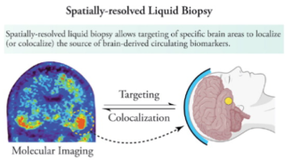 集束超音波技術により神経変性疾患のバイオマーカーを放出することに成功(Focused ultrasound technique leads to release of neurodegenerative disorders biomarkers)