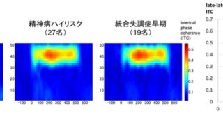 統合失調症の発症早期における聴覚関連脳波応答の特徴が明らかに