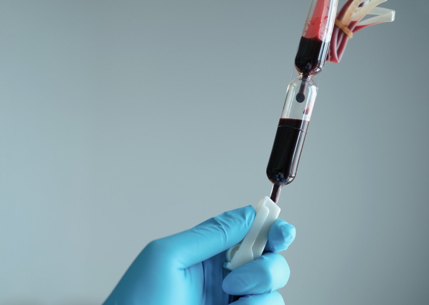 脳出血のリスクは輸血を介して伝達されるようだ(Risk of brain haemorrhage appears transmissible via blood transfusion)