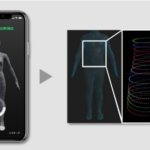 ZOZOSUIT®を用いた側弯症検知～ZOZOSUIT®によって中等症以上の側弯症の検知に成功～