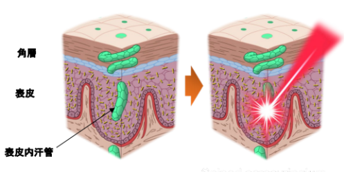 マウス発汗の三次元ライブイメージングに成功 ～汗関連疾患の病態解明に期待～