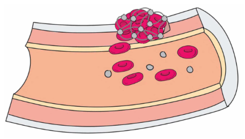 合成血小板が出血を止め、動物モデルで治癒を促進(Synthetic Platelets Stanch Bleeding, Promote Healing in Animal Models)