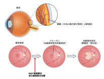 加齢黄斑変性の前駆病変が発生するしくみを発見～加齢黄斑変性予防に対する新たな治療確立に期待～
