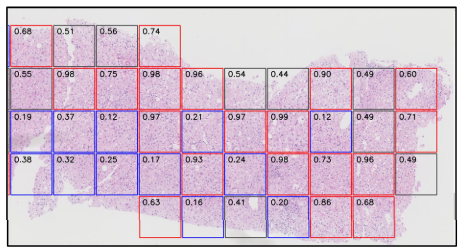 脂肪肝病理画像から発がんを予測するAIモデル～暗黙知が解き明かす肝がんのサイン～