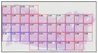 脂肪肝病理画像から発がんを予測するAIモデル～暗黙知が解き明かす肝がんのサイン～
