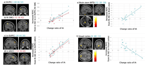 内受容感覚訓練が脳回路変化を誘導することを発見～心身症の新規治療法開発への期待～