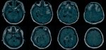 無反応の脳損傷患者の4人に1人が隠れた意識の兆候を示す(One in Four Brain-Injured Unresponsive Patients Show Signs of Hidden Consciousness)