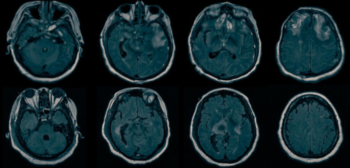 無反応の脳損傷患者の4人に1人が隠れた意識の兆候を示す(One in Four Brain-Injured Unresponsive Patients Show Signs of Hidden Consciousness)