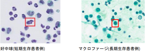 人工知能(AI)によって膵臓がん患者腹水中の生存関連因子を見つける～腹腔内の免疫細胞が膵臓がん患者の生存期間に影響～