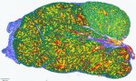 ショーグレン症候群のメカニズムの解明 (Researchers Reveal Mechanisms Underlying Sjogren&rsquo;s Disease)