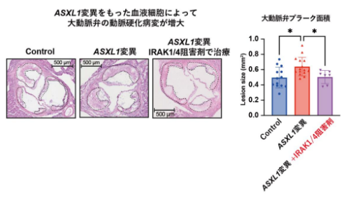 白血病関連遺伝子変異を有する血液が心筋梗塞や脳梗塞を誘導するメカニズムの解明～ASXL1変異は炎症の増悪と遷延化を介して動脈硬化を誘導する～