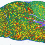 ショーグレン症候群のメカニズムの解明 (Researchers Reveal Mechanisms Underlying Sjogren’s Disease)