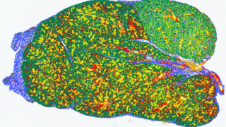 ショーグレン症候群のメカニズムの解明 (Researchers Reveal Mechanisms Underlying Sjogren’s Disease)