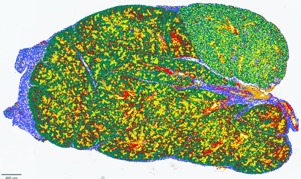 ショーグレン症候群のメカニズムの解明 (Researchers Reveal Mechanisms Underlying Sjogren’s Disease)