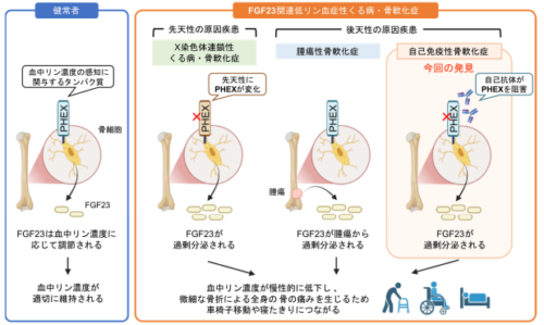 指定難病の骨軟化症を発症する新たなメカニズム「自己免疫性骨軟化症」を発見～骨軟化症の正確な診断に貢献、未知の自己免疫疾患の汎用的な検出の流れも確立～