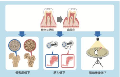 歯周炎による炎症は老化を促進して各種臓器の障害を招く～高齢者診療と歯科診療の連携による包括的な診療の重要性を示唆～