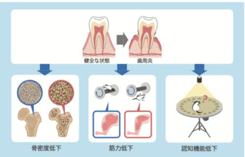 歯周炎による炎症は老化を促進して各種臓器の障害を招く~高齢者診療と歯科診療の連携による包括的な診療の重要性を示唆~ 歯周炎による炎症は老化を促進して各種臓器の障害を招く~高齢者診療と歯科診療の連携による包括的な診療の重要性を示唆~